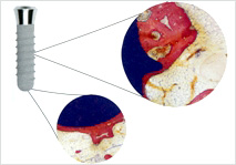 インプラントの原理2