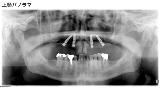 上顎パノラマ