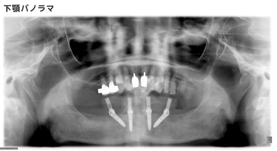 下顎パノラマ