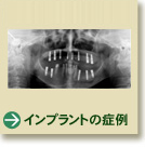 インプラントの症例