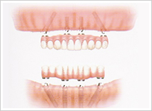 インプラントによる入れ歯固定