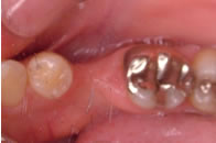 先天的な永久歯の欠損